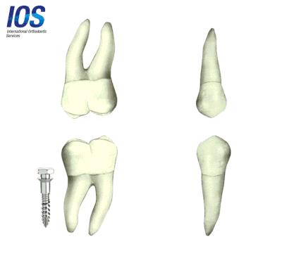 Biomechanics of Orthodontic mini implant Temporary anchorage device Tads